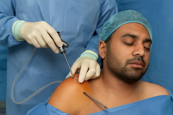Patient undergoing shoulder arthroscopy performed by orthopedic surgeon in Kolkata